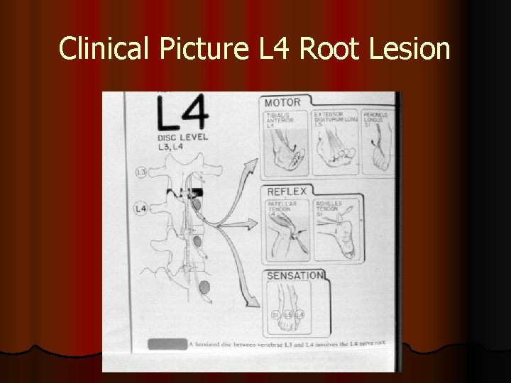 Clinical Picture L 4 Root Lesion 