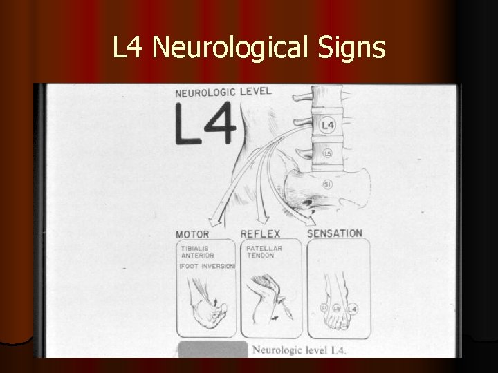 L 4 Neurological Signs 