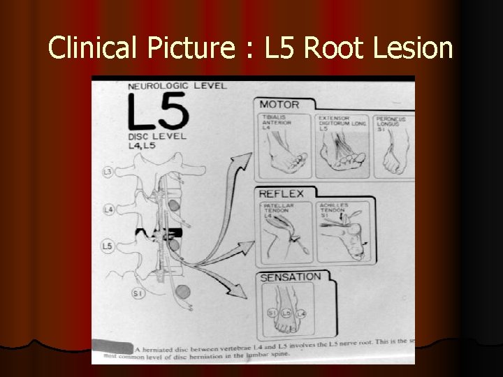 Clinical Picture : L 5 Root Lesion 