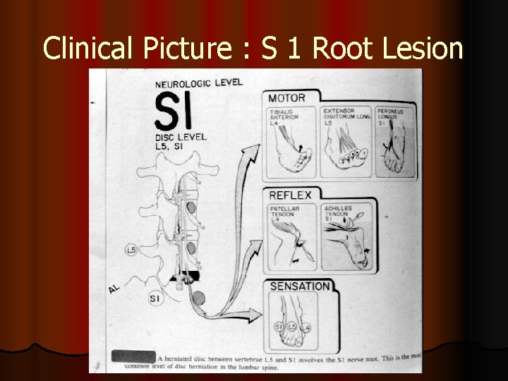 Clinical Picture : S 1 Root Lesion 