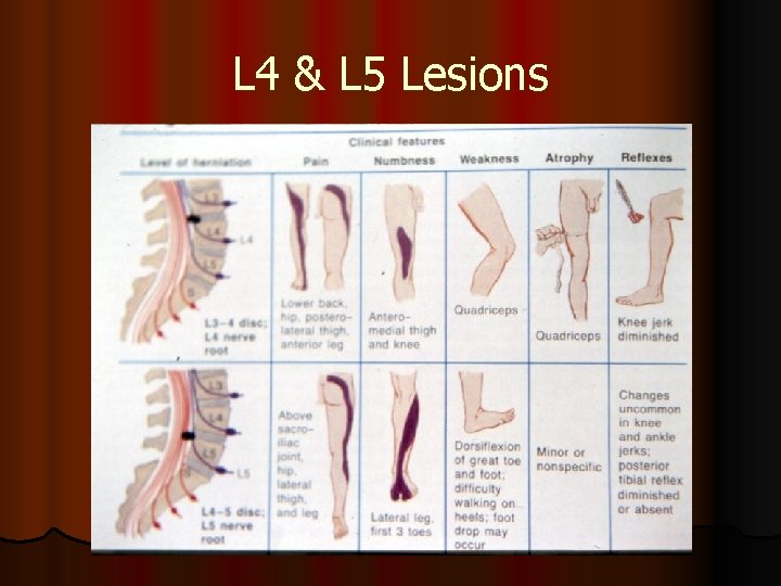 L 4 & L 5 Lesions 