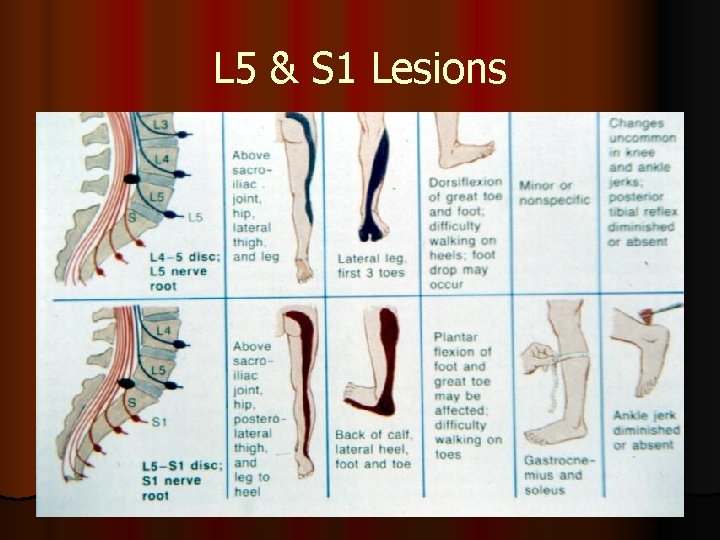 L 5 & S 1 Lesions 