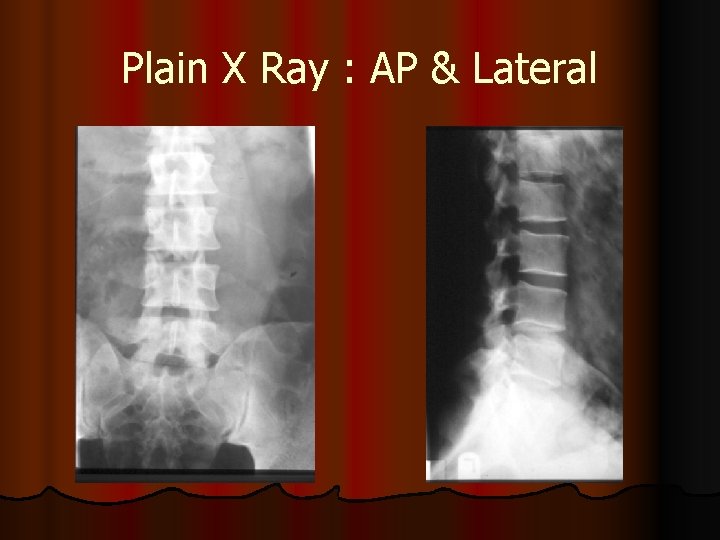 Plain X Ray : AP & Lateral 