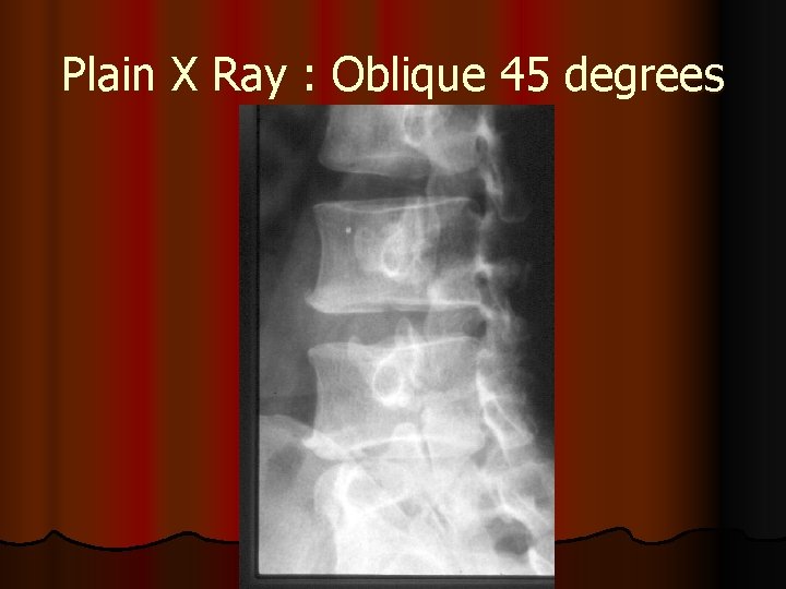 Plain X Ray : Oblique 45 degrees 