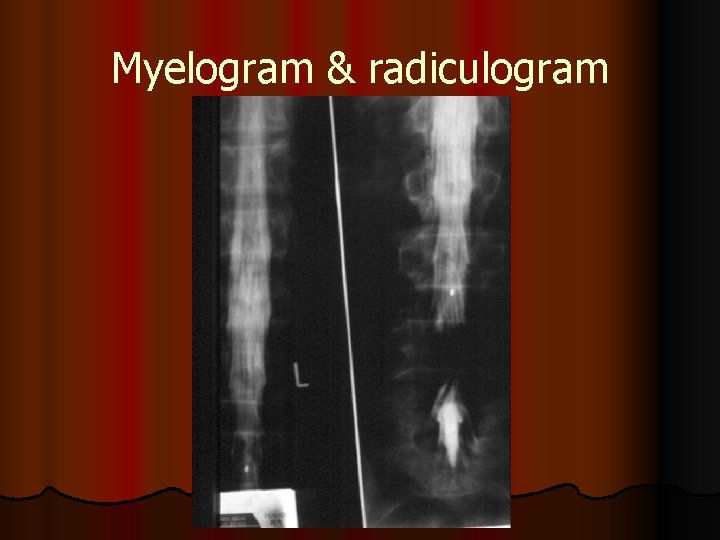 Myelogram & radiculogram 