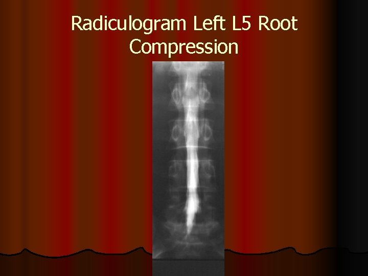 Radiculogram Left L 5 Root Compression 