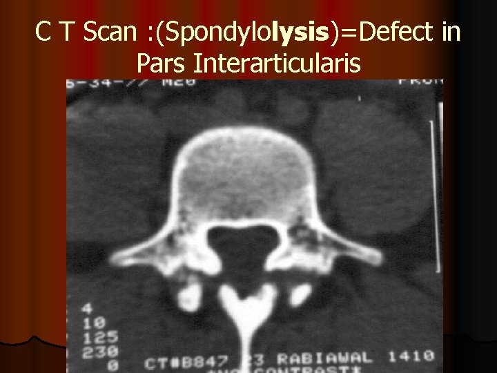 C T Scan : (Spondylolysis)=Defect in Pars Interarticularis 