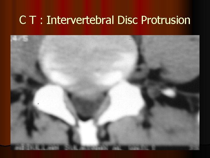 C T : Intervertebral Disc Protrusion 