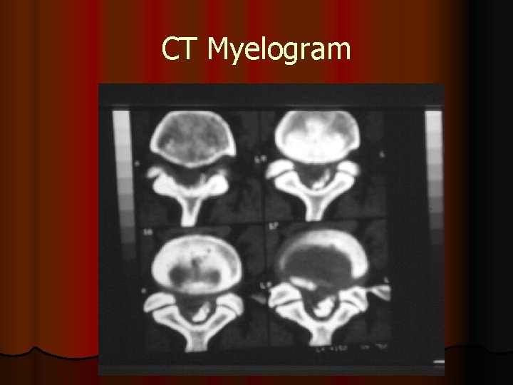 CT Myelogram 