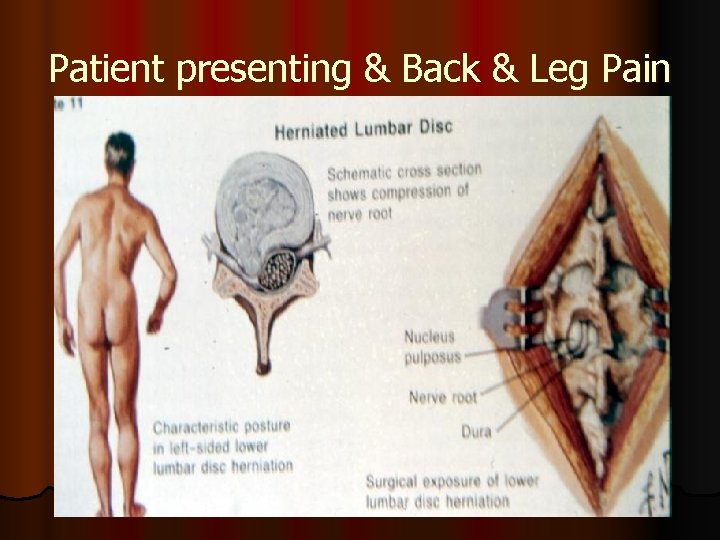 Patient presenting & Back & Leg Pain 