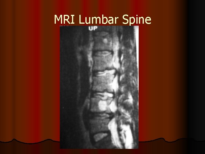 MRI Lumbar Spine 