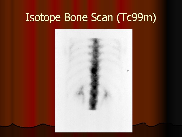 Isotope Bone Scan (Tc 99 m) 