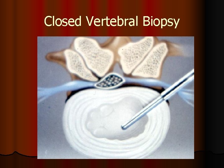 Closed Vertebral Biopsy 