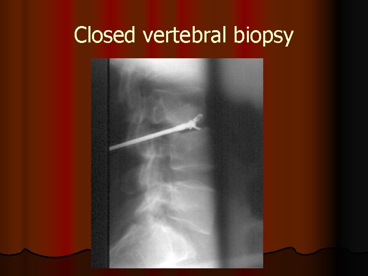 Closed vertebral biopsy 