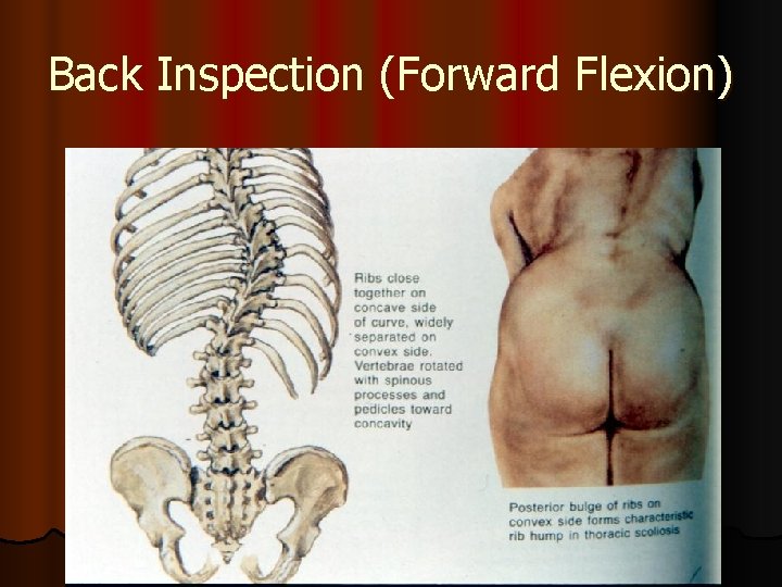 Back Inspection (Forward Flexion) 