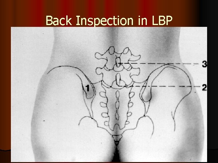 Back Inspection in LBP 