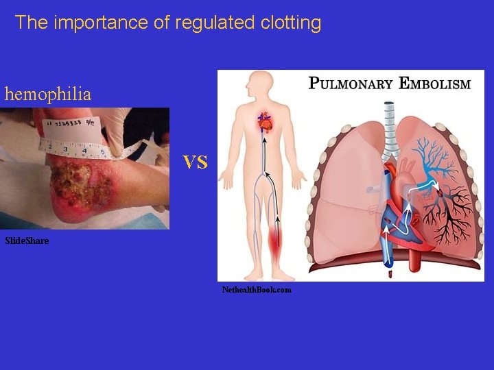 The importance of regulated clotting hemophilia VS Slide. Share Nethealth. Book. com 