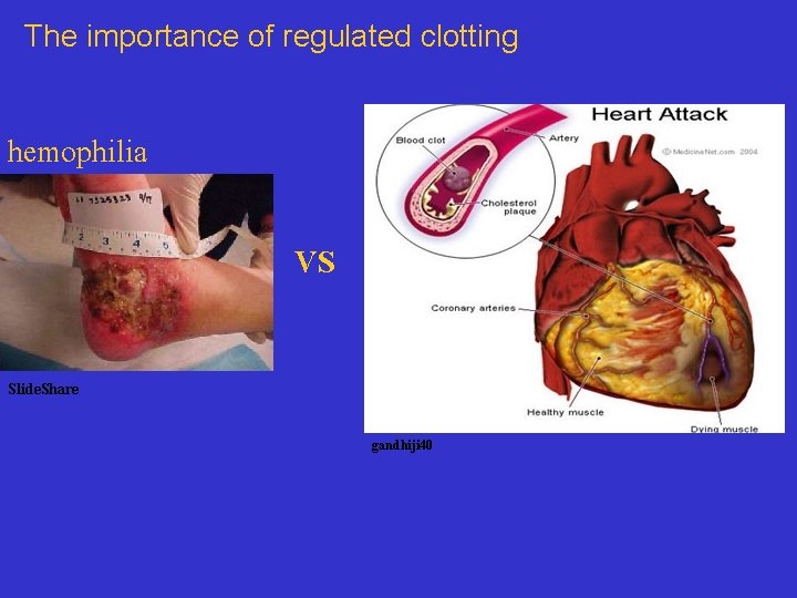 The importance of regulated clotting hemophilia VS Slide. Share gandhiji 40 