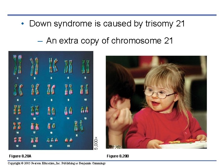  • Down syndrome is caused by trisomy 21 5, 000 – An extra