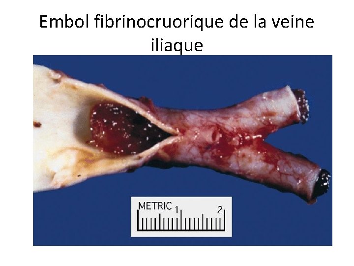 Embol fibrinocruorique de la veine iliaque 