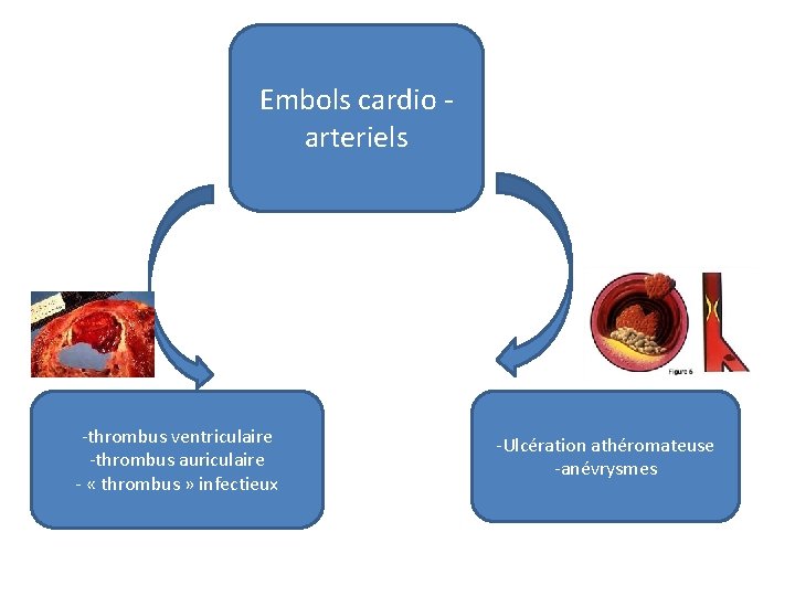 Embols cardio arteriels -thrombus ventriculaire -thrombus auriculaire - « thrombus » infectieux -Ulcération athéromateuse