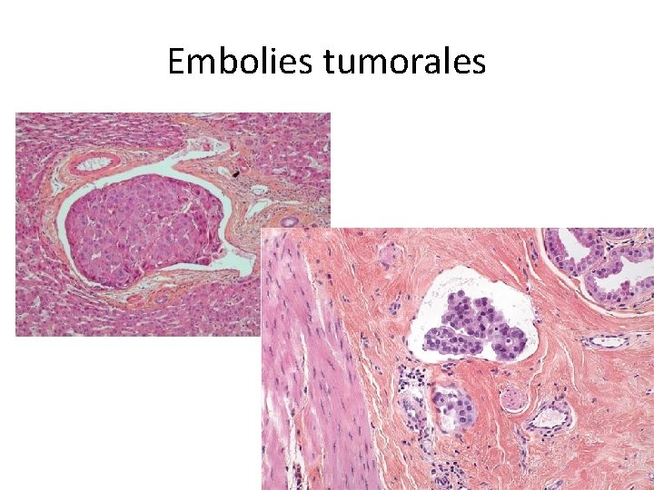 Embolies tumorales 