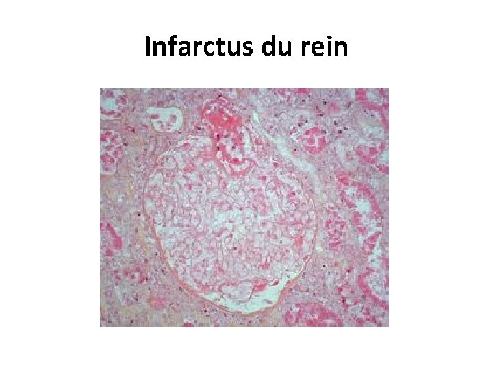 Infarctus du rein 