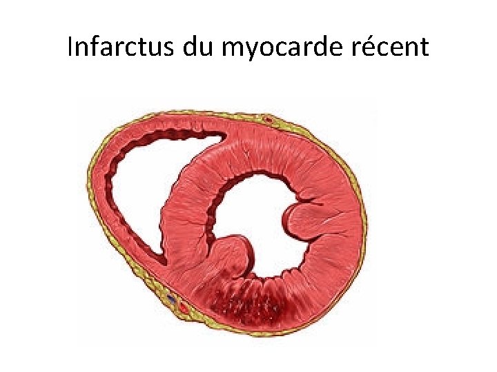 Infarctus du myocarde récent 