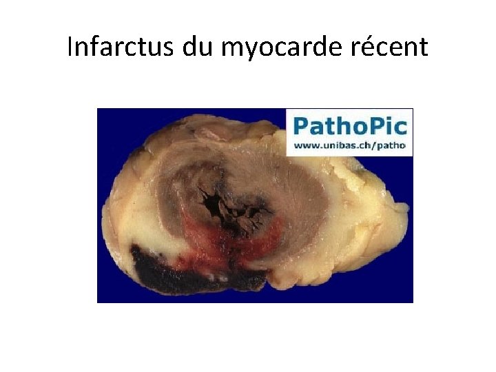 Infarctus du myocarde récent 