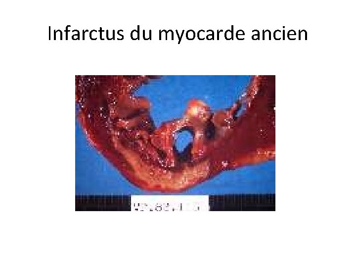 Infarctus du myocarde ancien 
