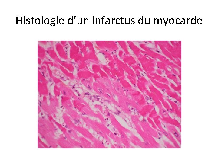 Histologie d’un infarctus du myocarde 
