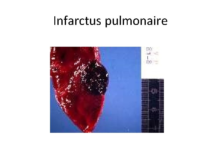 Infarctus pulmonaire 