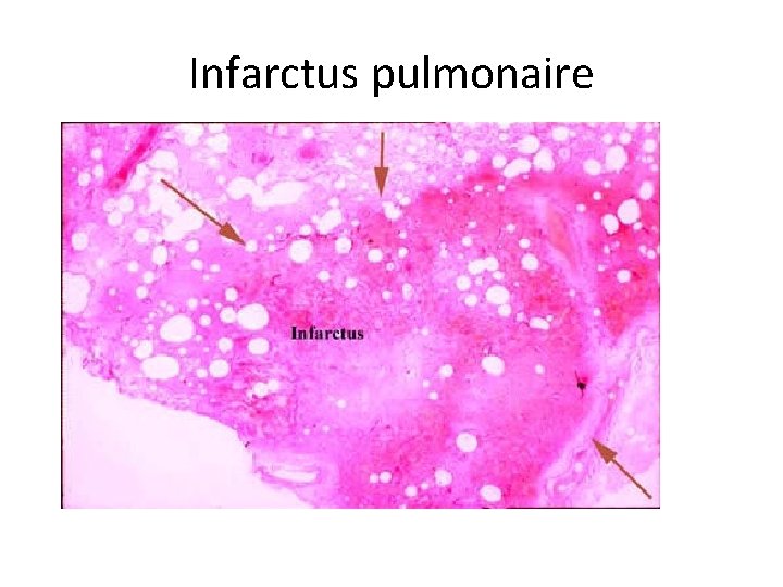 Infarctus pulmonaire 