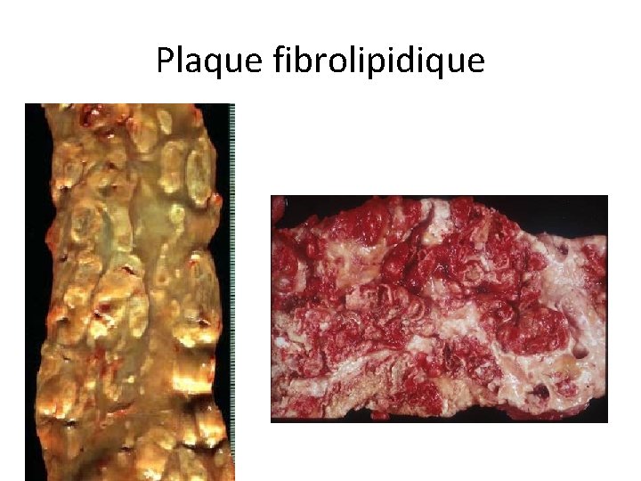 Plaque fibrolipidique 