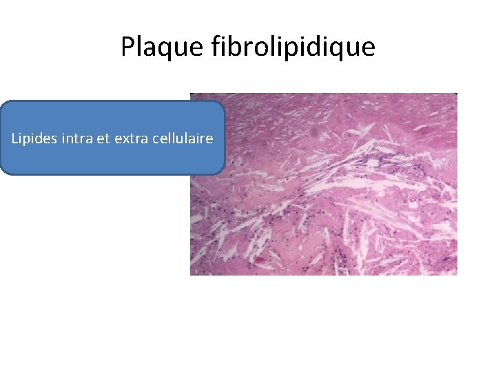 Plaque fibrolipidique Lipides intra et extra cellulaire 