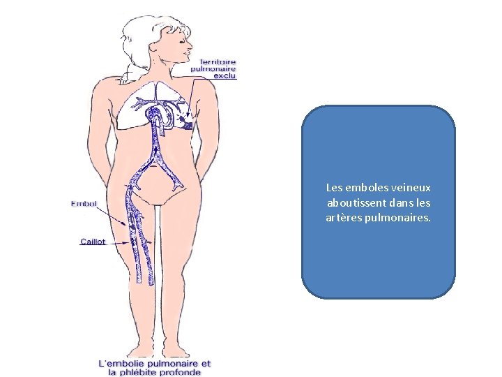 Les emboles veineux aboutissent dans les artères pulmonaires. 