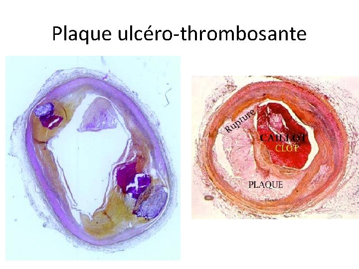 Plaque ulcéro-thrombosante 