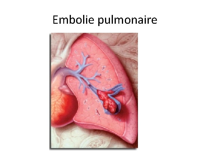 Embolie pulmonaire 