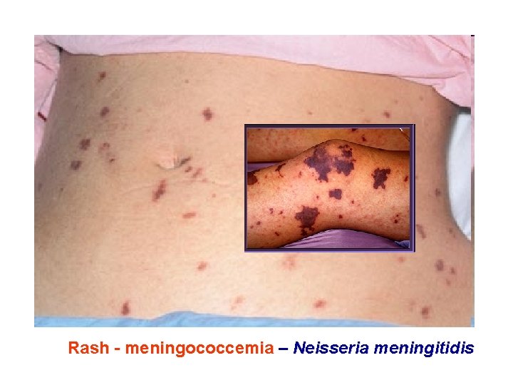 Rash - meningococcemia – Neisseria meningitidis 