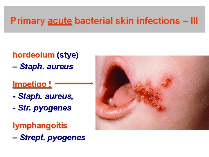 Primary acute bacterial skin infections – III hordeolum (stye) – Staph. aureus Impetigo !