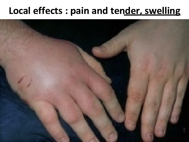 Local effects : pain and tender, swelling 