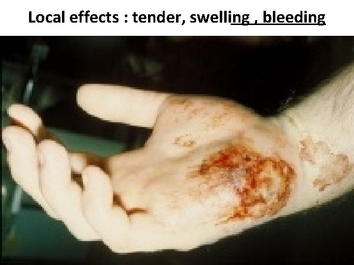Local effects : tender, swelling , bleeding 