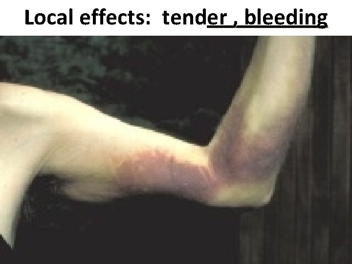 Local effects: tender , bleeding 