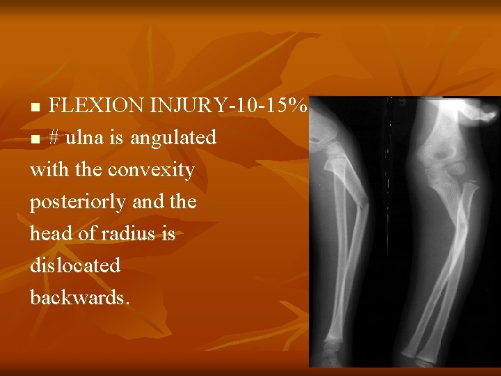 FLEXION INJURY-10 -15% n # ulna is angulated with the convexity posteriorly and the