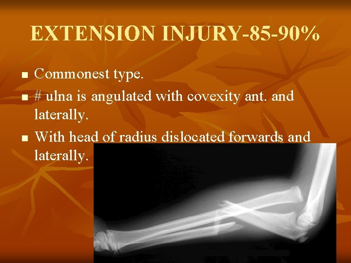 EXTENSION INJURY-85 -90% n n n Commonest type. # ulna is angulated with covexity