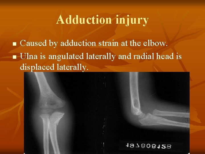 Adduction injury n n Caused by adduction strain at the elbow. Ulna is angulated