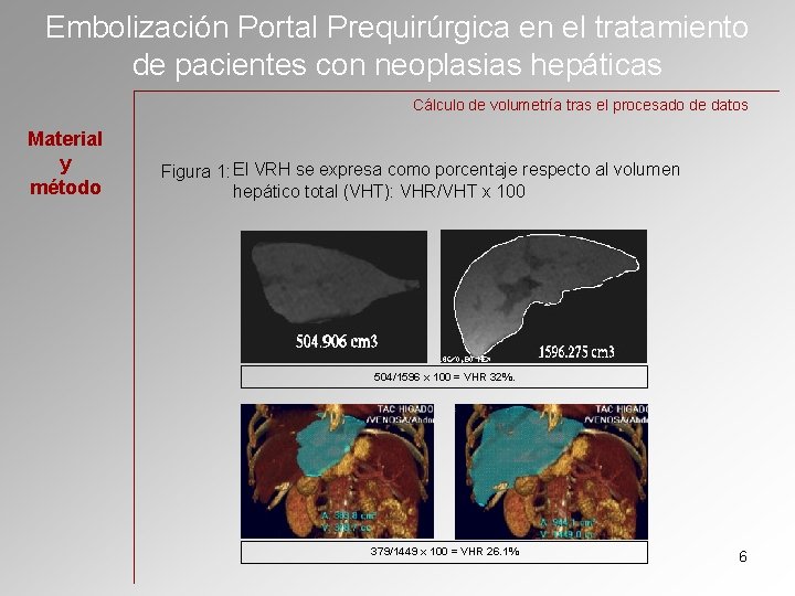 Embolización Portal Prequirúrgica en el tratamiento de pacientes con neoplasias hepáticas Cálculo de volumetría