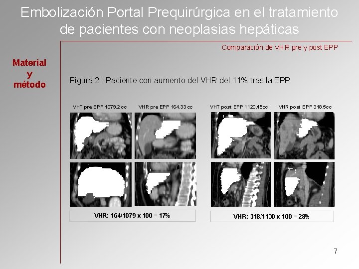 Embolización Portal Prequirúrgica en el tratamiento de pacientes con neoplasias hepáticas Comparación de VHR