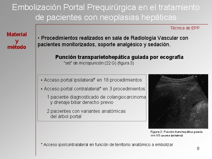 Embolización Portal Prequirúrgica en el tratamiento de pacientes con neoplasias hepáticas Técnica de EPP