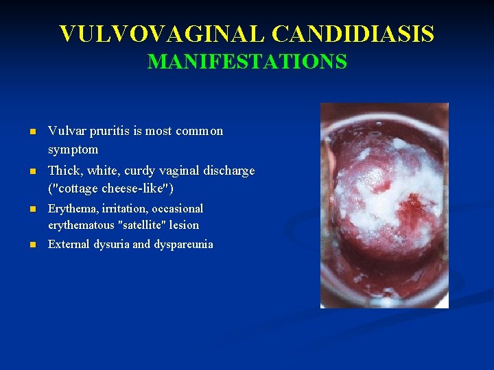 VULVOVAGINAL CANDIDIASIS MANIFESTATIONS n Vulvar pruritis is most common symptom n Thick, white, curdy
